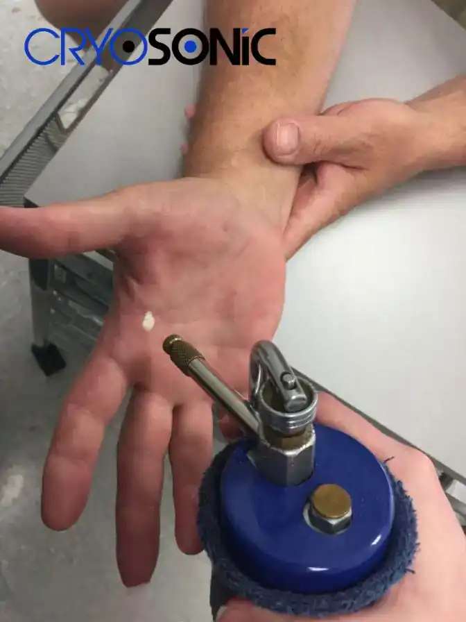 Temperature Differences: OTC vs Medical-Grade Cryotherapy Dartford